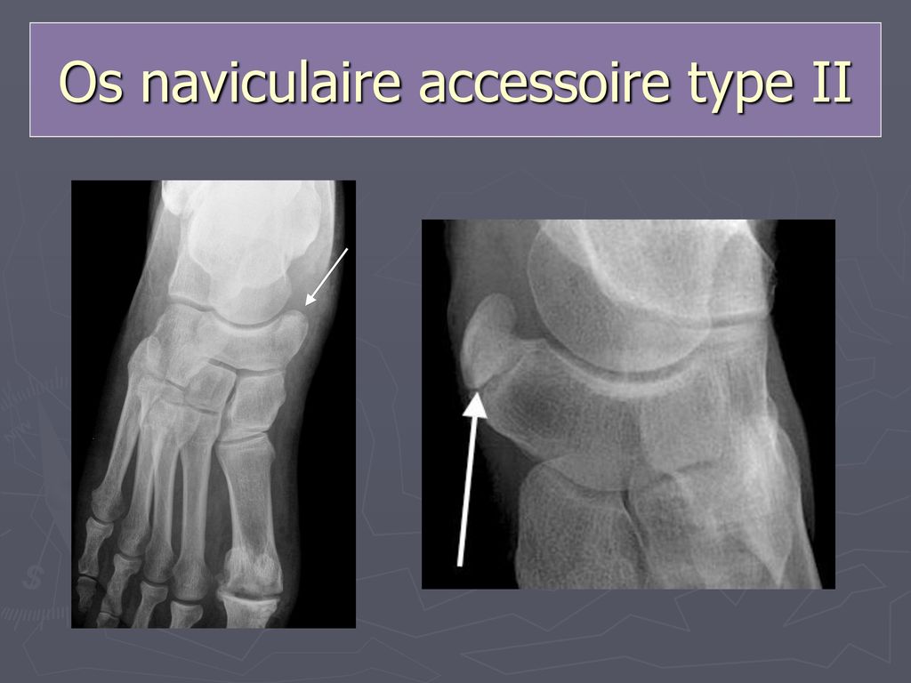 d os naviculaire accessoire I II et III ppt video online